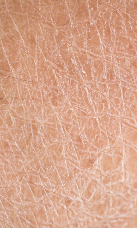 dry skin (ichthyosis) detail